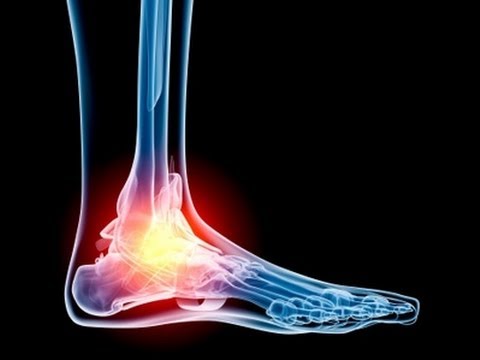 ankle-replacement-surgery-3d-printing-3[1]